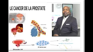 Cancer de la Prostate