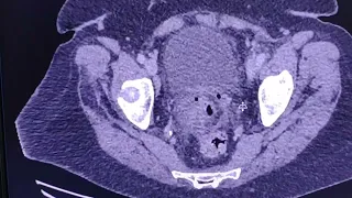 Abdominal collections / abscesses and peritonitis (post operative complications) - CT findings