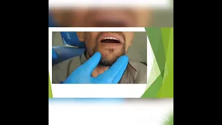 Try in of complete denture