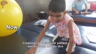 Spastic Quadriplegic Cerebral Palsy Treatment Results | Quick Look | No. 3413