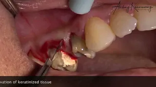 Crown Lengthening of Maxillary premolars with a surprise!