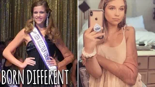 Pageant Queen Has Tumours On Half Her Body | BORN DIFFERENT