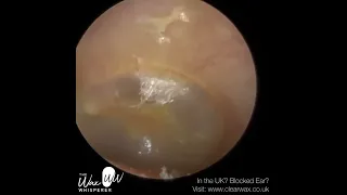 1,098   Dead Skin Peel off Eardrum and Ear Canal​ 001