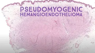 Pseudomyogenic hemangioendothelioma (epithelioid sarcoma mimic)(Australasian Dermpath 2022 Case 10)