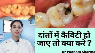 दांतो की कैविटी कैसे हटाएं?||Dant Mein Kala Chhed Ya Kide Ka Ilaj||Tooth Cavity Pain Treatment