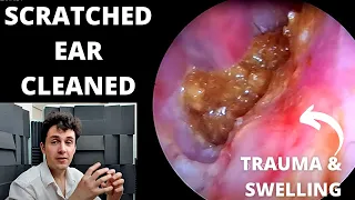 Scratched Swollen Ear Cleaned Using Suction (PAMPS & DAMPS Explained)