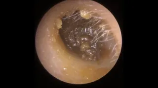 761 - Fully Compacted Ear Wax Removal