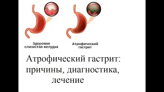 Атрофический гастрит: причины, диагностика, лечение