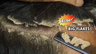 Itchy Scalp Dandruff Removal Satisfying #560