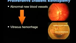 Retinopathy - Saving Sight 2014