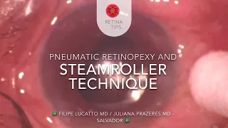 Pneumatic Retinopexy and the Steamroller technique