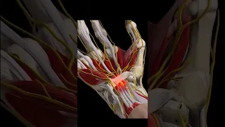 Carpal Tunnel Syndrome - Surgeon