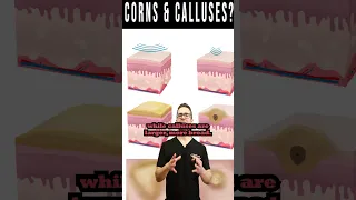 Foot CORNS & CALLUSES: How To Get Rid Of Them For Good!