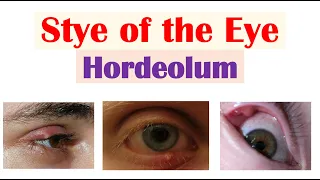 Eye Stye (Hordeolum) | Causes, Symptoms, Diagnosis & At Home Treatments