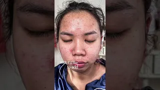 Acne Journey #acne #acnetreatment #acnescars #acnejourney #acneproneskin #shorts