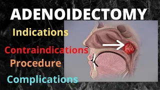 Adenoidectomy  #adenotonsillectomy