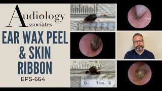 EAR WAX PEEL & SKIN RIBBON - EP664