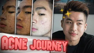 HOW I CLEARED MY SKIN ||  My Accutane journey + current skincare routine (affordable)