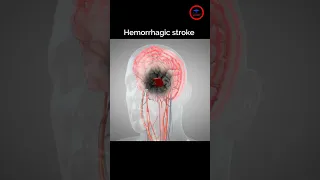 The goal of Treat Hemorrhagic stroke ,, #stroke #bleeding