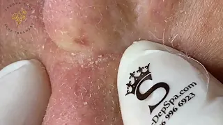 Top Satisfying Relaxing with Best Video SAC DEP Beauty & Acne Spa #333