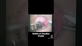 Excision of Pterygium (Pugita)