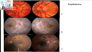 AIOC2019   GP164   Topic    Approach to Patients with Optic Disc Edema and Pallor   Dr  Rohit Saxena