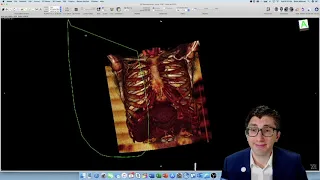 How-To: Creating a 3D Reconstruction of Your Patient's CT Scan