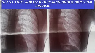 Отдалённые последствия вируса! Чего стоит бояться переболевшим и что делать дальше