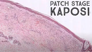 Dermpath misdiagnosis pitfall! Patch Stage Kaposi sarcoma (pathology dermatology dermatopathology)