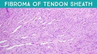 Fibroma of tendon sheath (explained in 5 minutes) finger mass dermpath soft tissue tumor pathology