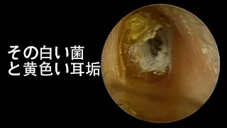 Relaxing Earwax Removal -- Look At That White Fungus and Yellow Earwax