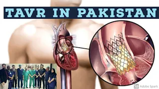 TAVR |TRANSCATHETER AORTIC VALVE REPLACEMENT WEBINAR|TAVR| TAVI | TAVR IN PAKISTAN