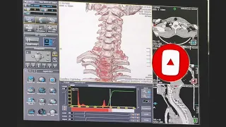 شرح فحص الاشعه المقطعيه علي الفقرات العنقيه علي جهاز توشيبا / CT Cervical Spine