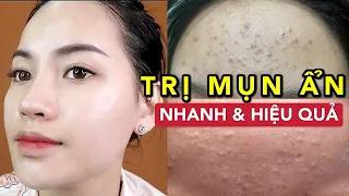 TRỊ MỤN ẨN, MỤN ĐẦU ĐEN, DA SẦN SÙI NHANH VÀ HIỆU QUẢ !!! DA TRƠN LÁNG CHỈ SAU 2 THÁNG !!!