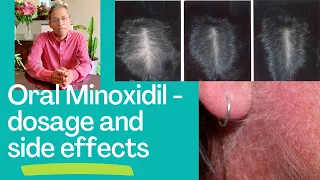 Oral Minoxidil for hair disorders - dosage and side effects