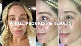 My VI PEEL Daily Progress and Results | first VI peel experience, dermaplaning, post-peel skincare