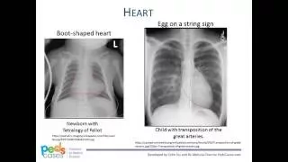 Approach to Pediatric Chest X-Rays