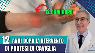 Protesi di caviglia 12 anni dopo l'intervento | Dott. Andrea Scala