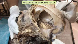 Dural folds and Dural venous sinuses