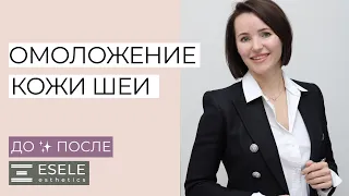 ПРОЦЕДУРА ОМОЛОЖЕНИЯ ПРЕПАРАТОМ RADIESSE. Делаю Омоложение Шеи.