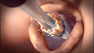 Transcatheter Aortic Valve Implantation (TAVI)