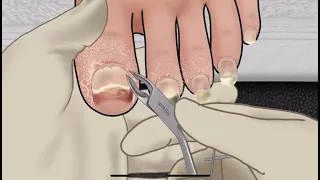 ASMR Animation for the treatment of athlete's foot |  Oddly Satisfying Video