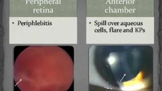 Ophthalmology - Uvea Class1: Overview of uveitis Part3