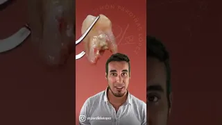 ♦️La IMPORTANCIA de QUITAR el SARRO de tus dientes - Muela que se mueve