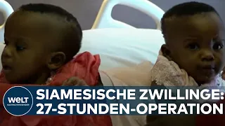 SIAMESISCHE ZWILLINGE: OP dauerte 27 Stunden! Elisabeth und Mary aus Kamerun erfolgreich getrennt