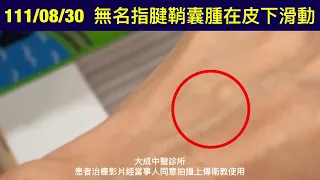 腱鞘囊腫針灸1次消失