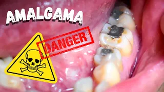 Amalgama dental es Toxica/Si tienes una debes ver este video