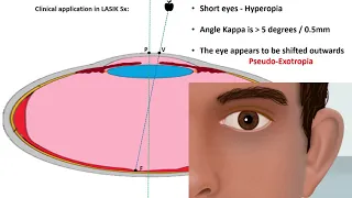 SQUINT VIDEO LECTURE SERIES PART 1 Dr Zain Khatib