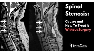 Spinal Stenosis: Causes and How to Treat It Without Surgery