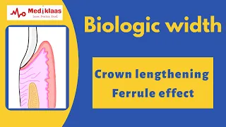 Biologic Width - A clinical review l Operative dentistry l Crown lengthening procedure l Mediklaas